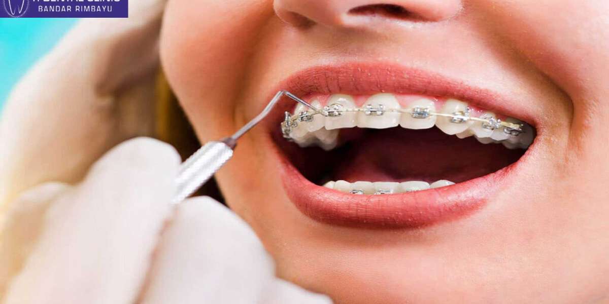 Teeth Veneers: Enhancing Smiles for Adults and Teens (Tidental)